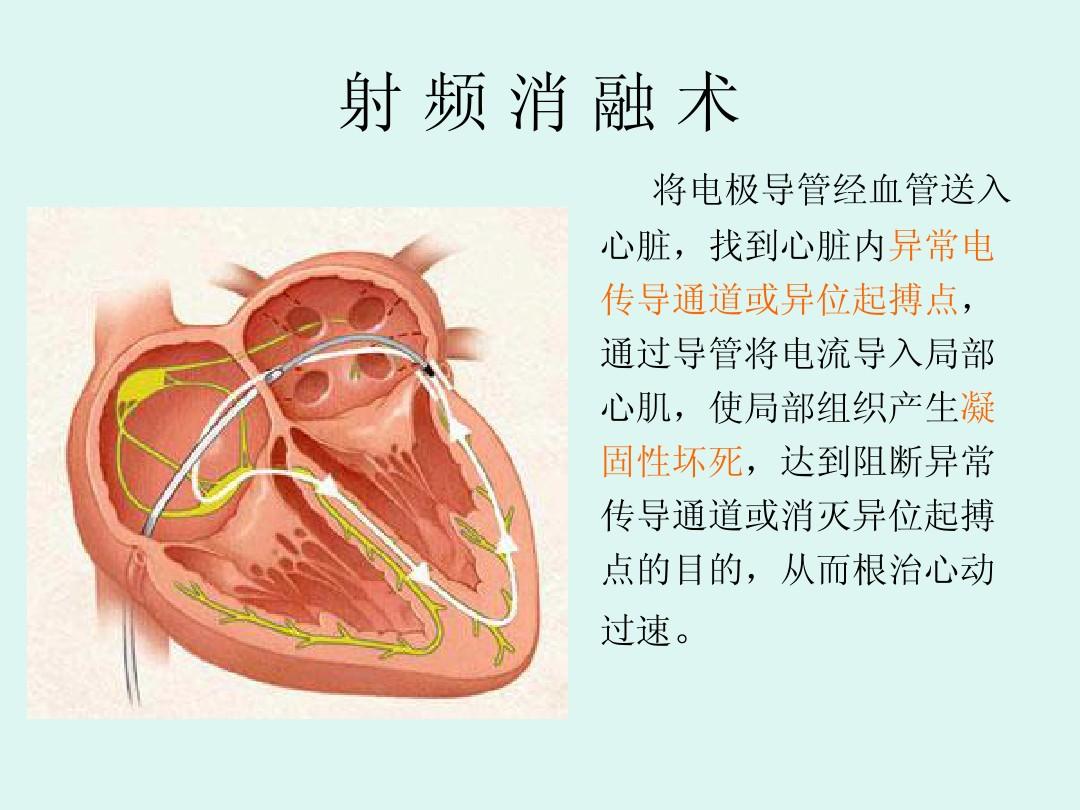 射频消融术