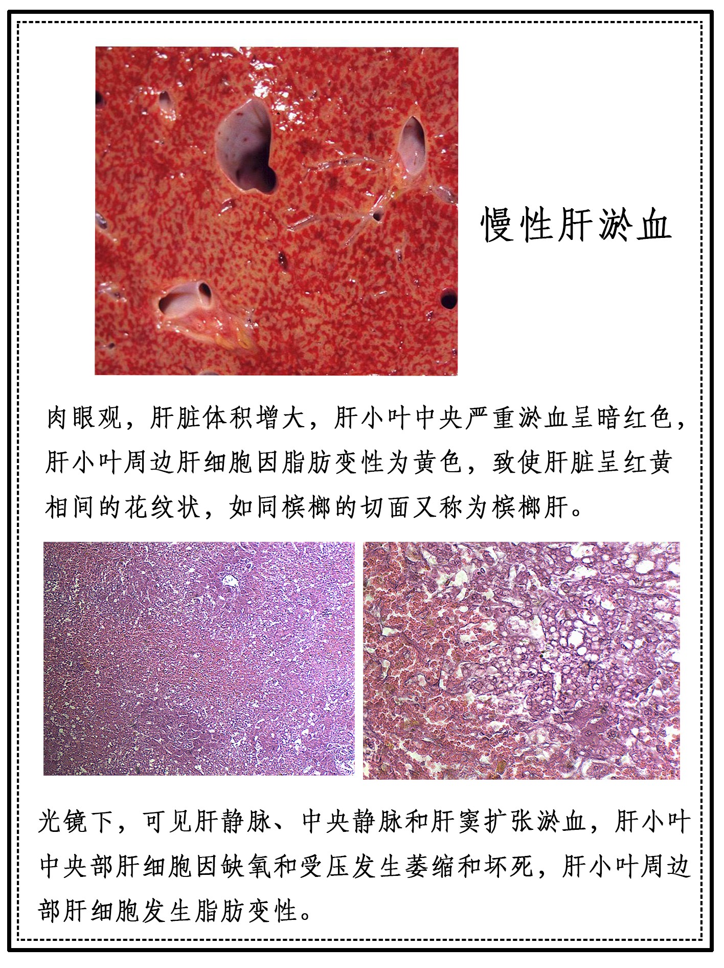 HL0302慢性肝淤血.jpg
