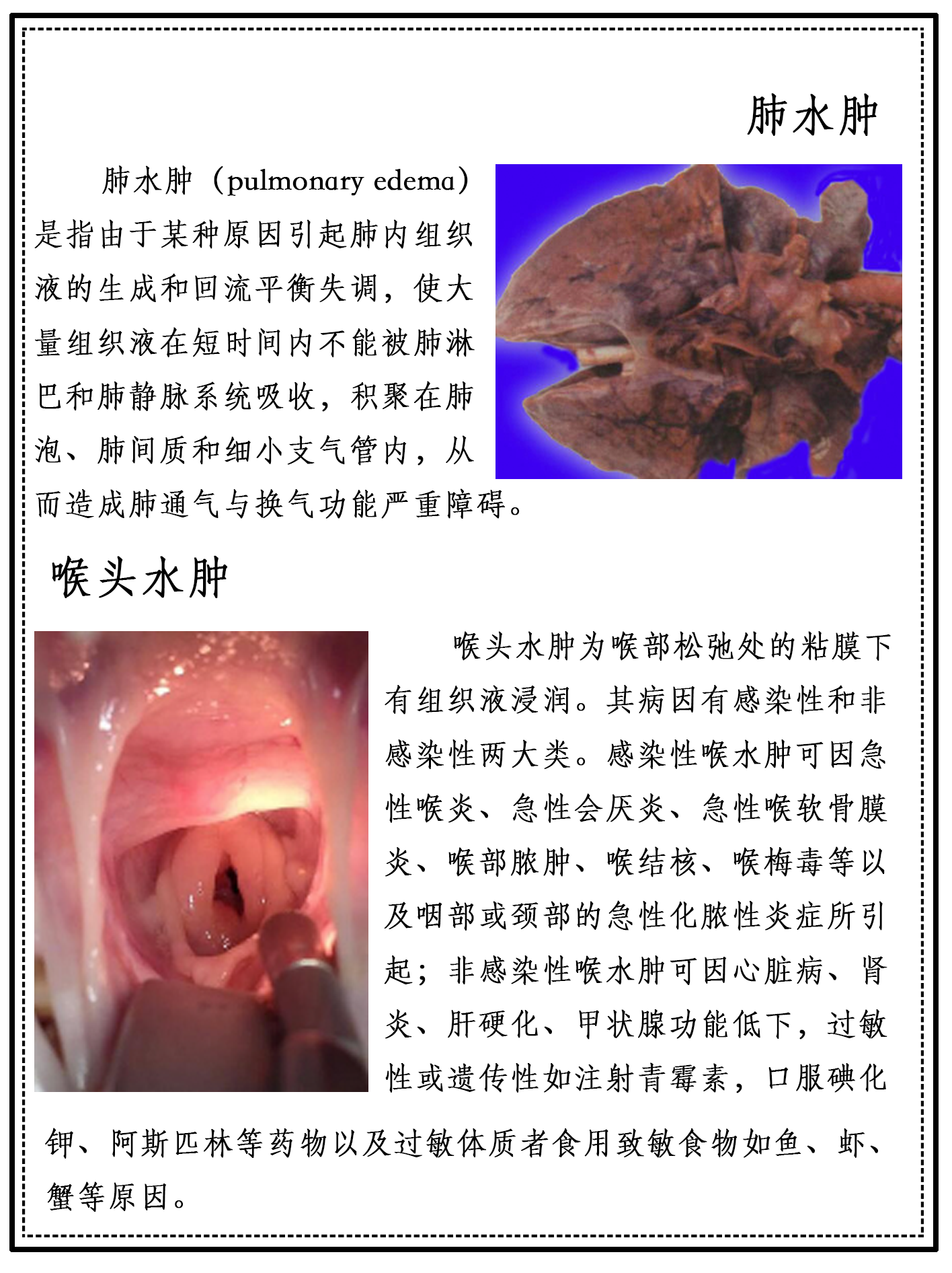 HL0702肺水肿、喉头水肿.png