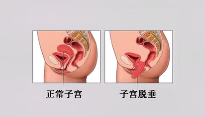 正常子宫与子宫脱垂对比图.png