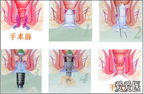 痔疮四步注射法.jpg