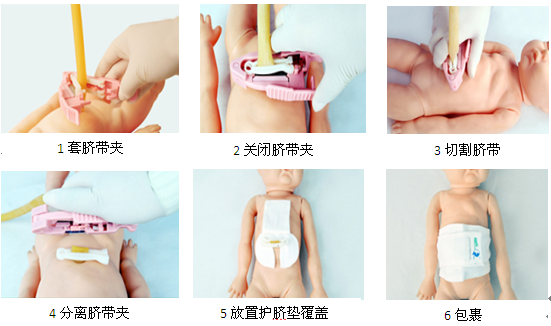 脐带夹脐带结扎法.png