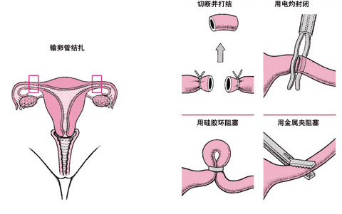 输卵管绝育术.png