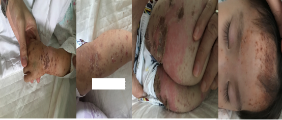 入院第五天Cox A6手足口病患者皮疹1.png