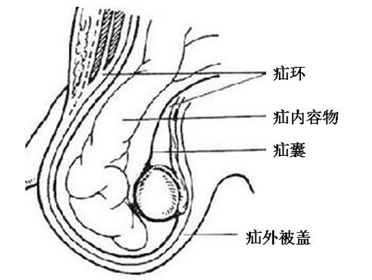 股疝气的症状图片