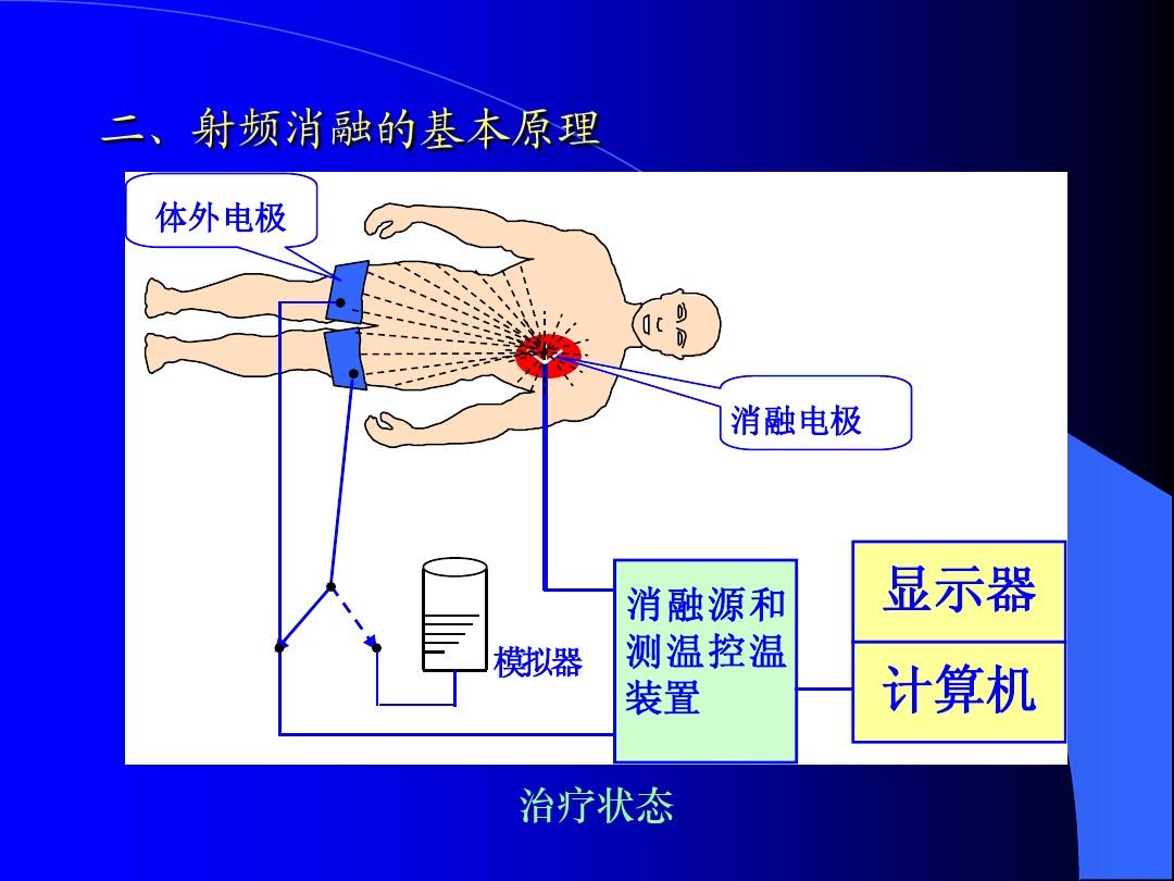 射频消融术