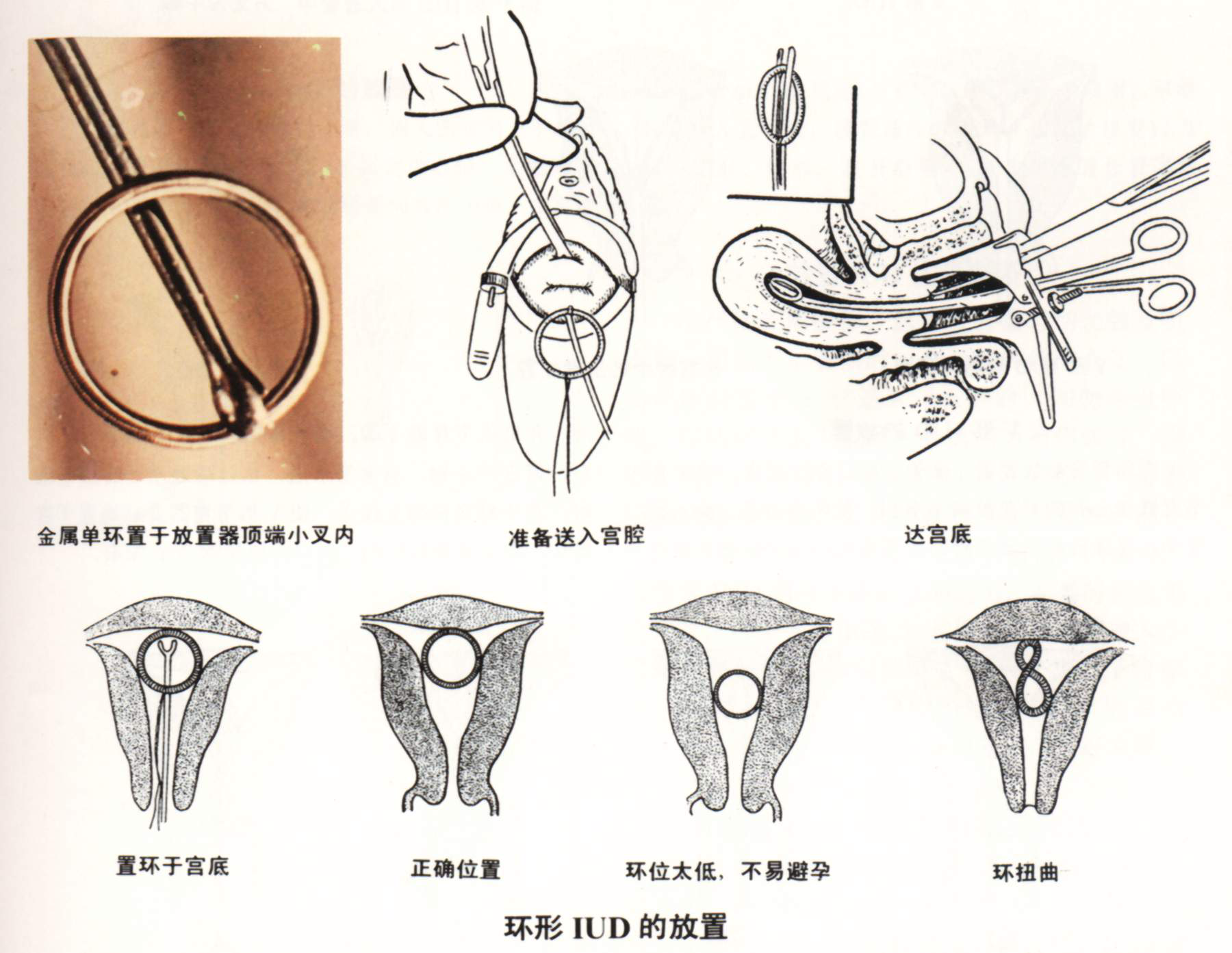 ③沿宫腔方向将叉偏水平位通过宫颈管后转正