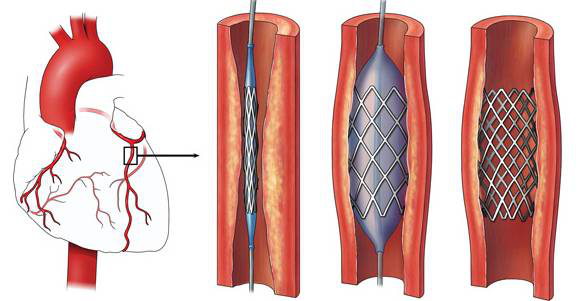 冠心病的治療